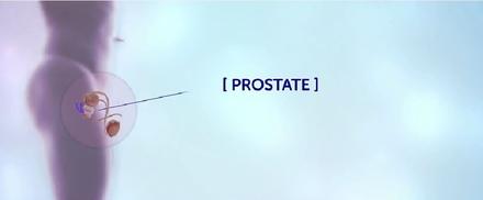 Prostate cancer treatment support thumbnail image