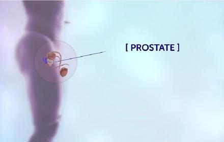 Prostate cancer treatment support thumbnail image
