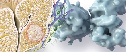 Prostate cancer infographic  immagine di anteprima